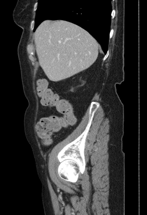 Cholecystoduodenal fistula due to calculous cholecystitis with gallstone migration (Radiopaedia 86875-103077 F 48).jpg