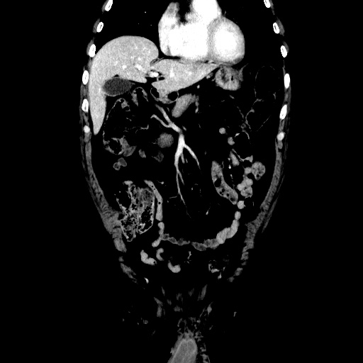 Choledocholiathiasis with normal caliber common bile duct (Radiopaedia 75368-86632 Coronal liver window 43).jpg