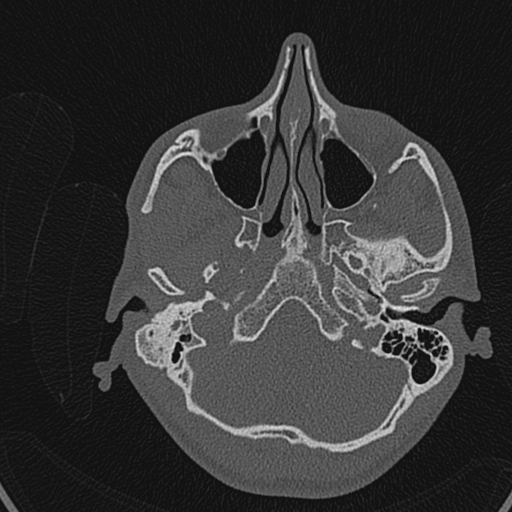 Cholesteatoma (Radiopaedia 70429-80529 Axial bone window 72).jpg