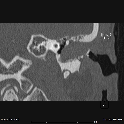 Cholesteatoma - external auditory canal (Radiopaedia 88452-105096 Coronal bone window 22).jpg