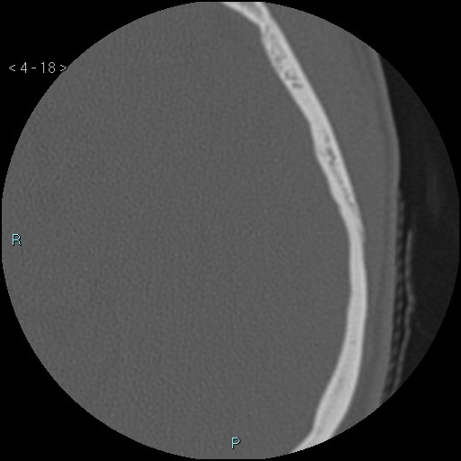 File:Cholesterol granuloma of the petrous apex (Radiopaedia 64358-73141 Axial bone window 9).jpg