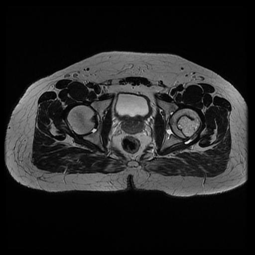 File:Chondroblastoma (Radiopaedia 12264-12564 Axial T2 5).jpg