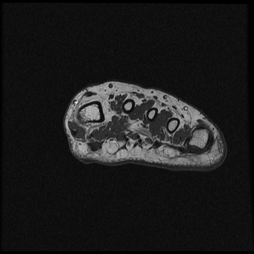File:Chondroblastoma - midfoot (Radiopaedia 64831-73765 Short axis T1 29).jpg