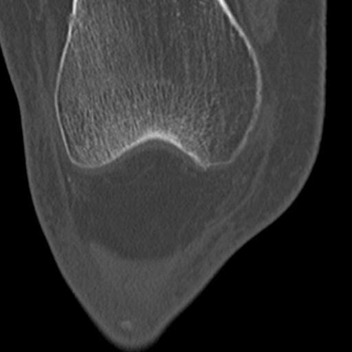 Chondrocalcinosis (Radiopaedia 16275-15955 Coronal bone window 18).jpg