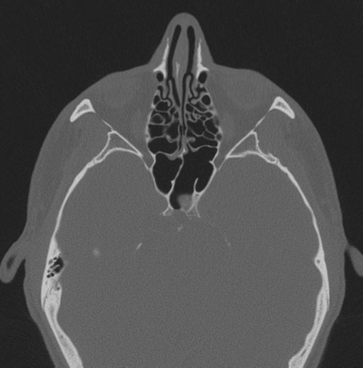 Chondrosarcoma (clivus) (Radiopaedia 46895-51425 Axial bone window 37).png