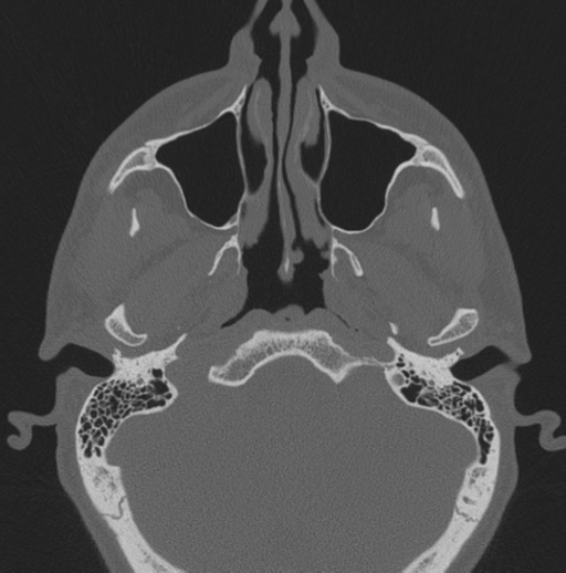 Chondrosarcoma (clivus) (Radiopaedia 46895-51425 Axial bone window 60).png