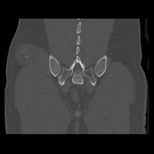 Chondrosarcoma of iliac wing (Radiopaedia 63861-72599 Coronal bone window 95).jpg