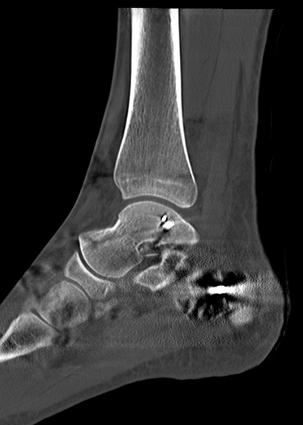 Chopart fracture (Radiopaedia 35347-36861 Sagittal bone window 41).jpg