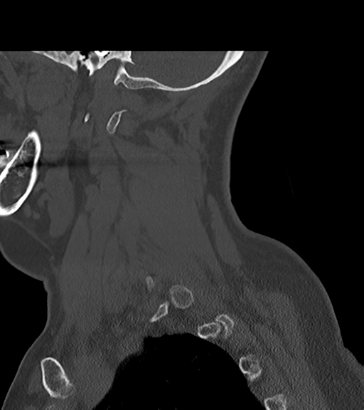 File:Chordoma (C4 vertebra) (Radiopaedia 47561-52188 Sagittal bone window 17).png