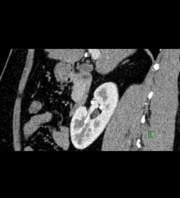 Chromophobe renal cell carcinoma (Radiopaedia 84286-99573 F 108).jpg
