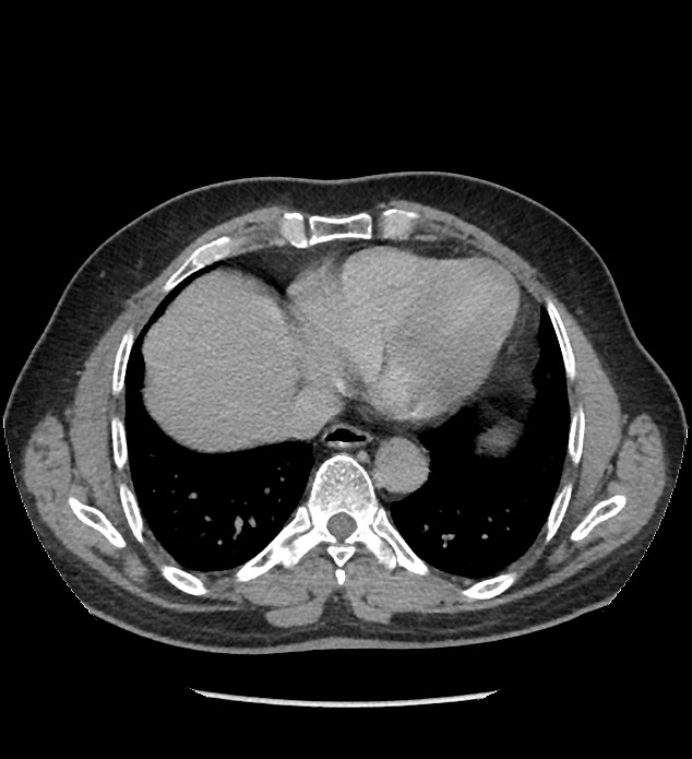 Chromophobe renal cell carcinoma (Radiopaedia 86879-103083 D 4).jpg