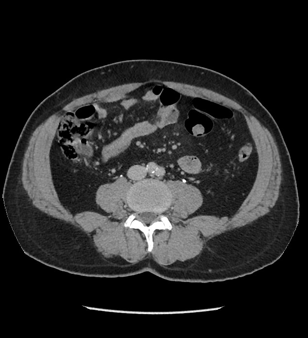 Chromophobe renal cell carcinoma (Radiopaedia 86879-103083 D 85).jpg