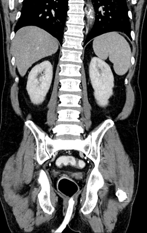 Chronic appendicitis complicated by appendicular abscess, pylephlebitis and liver abscess (Radiopaedia 54483-60700 C 59).jpg