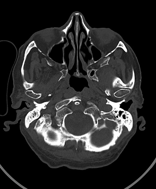 Chronic bilateral subdural hygroma (Radiopaedia 85801-101623 Axial bone window 103).jpg