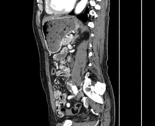 Chronic contained rupture of abdominal aortic aneurysm with extensive erosion of the vertebral bodies (Radiopaedia 55450-61901 B 49).jpg