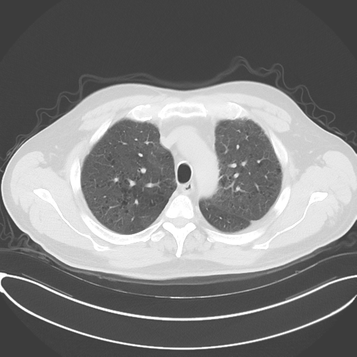 Chronic hypersensitivity pneumonitis (Radiopaedia 48107-52922 Axial lung window 19).png