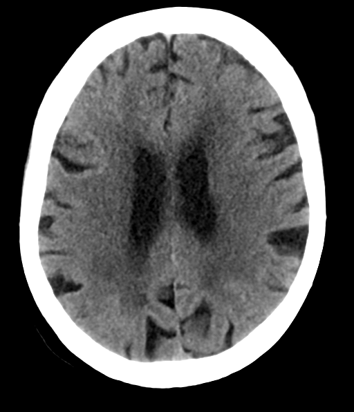 File:Chronic hypertensive encephalopathy (Radiopaedia 39993-42485 Axial non-contrast 22).png