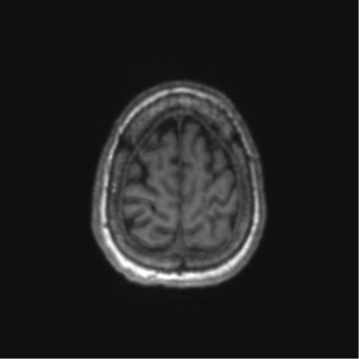 Chronic hypertensive encephalopathy (Radiopaedia 72844-83495 Axial T1 11).png