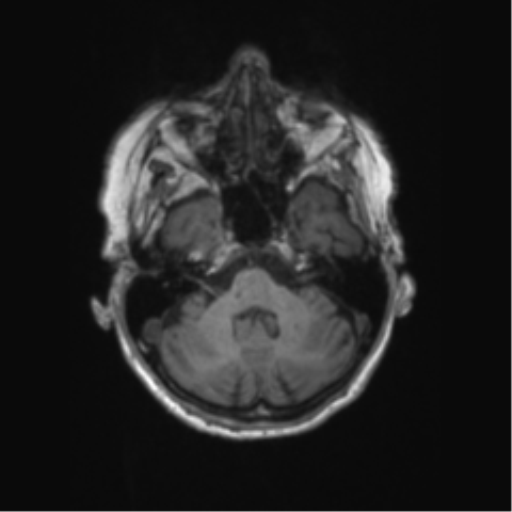Chronic hypertensive encephalopathy (Radiopaedia 72844-83495 Axial T1 56).png