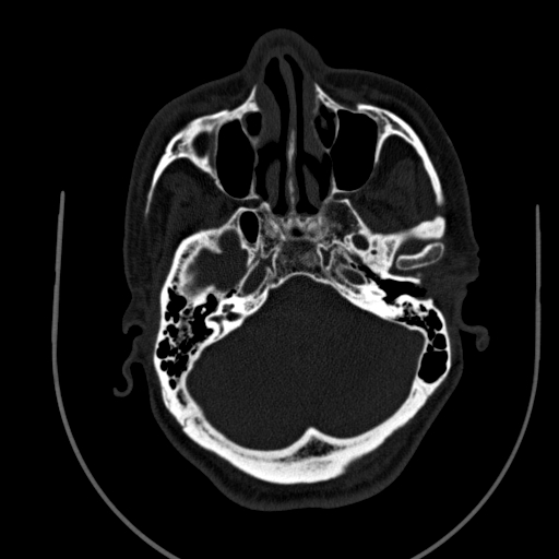 File:Chronic invasive fungal sinusitis (Radiopaedia 91563-109286 Axial sinus 38).jpg