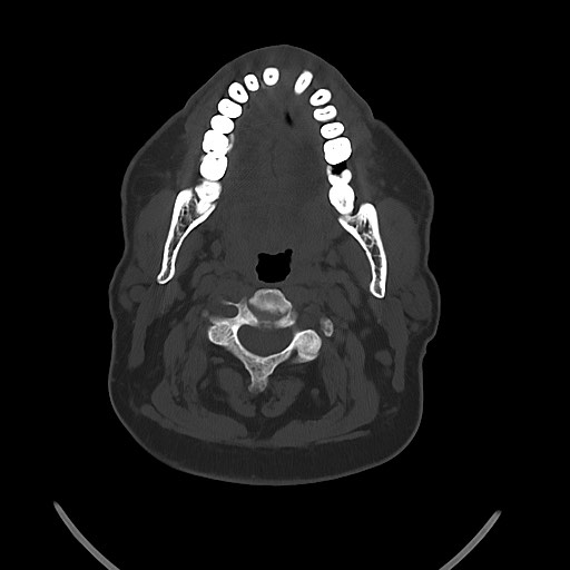Chronic osteomyelitis - calvarial (severe) (Radiopaedia 69668-79616 Axial bone window 12).jpg