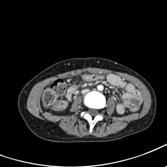 Chronic pancreatitis (Radiopaedia 55405-61846 A 59).jpg
