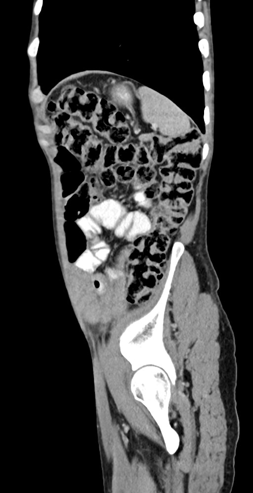 Chronic small bowel volvulus (Radiopaedia 75224-86322 C 33).jpg