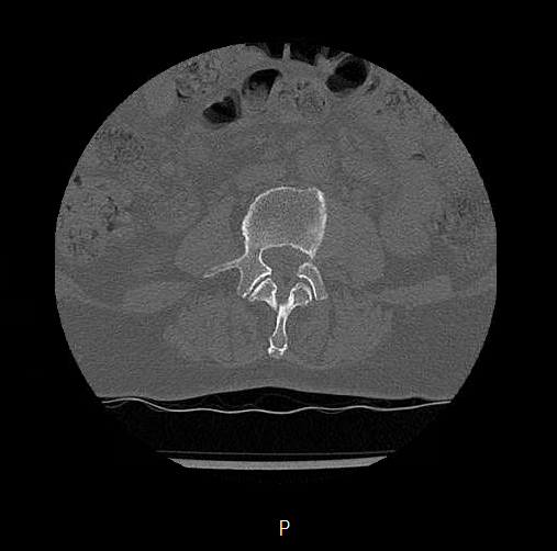File:Chronic spinal hematoma with cauda equina syndrome (Radiopaedia 75745-88197 Axial bone window 14).png