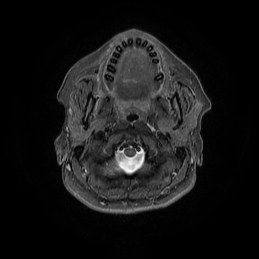 File:Chronic submandibular sialadenitis (Radiopaedia 61852-69885 Axial STIR 8).jpg