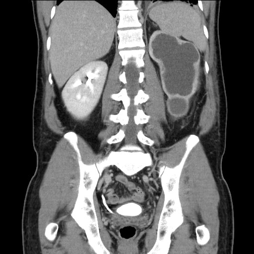 Chronic ureteropelvic junction obstruction (Radiopaedia 78365-90996 B 70).jpg