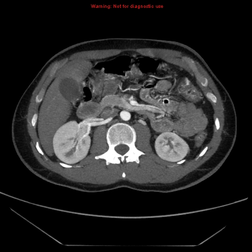File:Circumaortic left renal vein (Radiopaedia 9069-9792 A 21).jpg