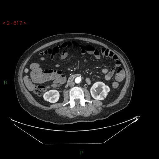 Circumaortic left renal vein and doubled left renal arteries (Radiopaedia 52268-58158 A 153).jpg