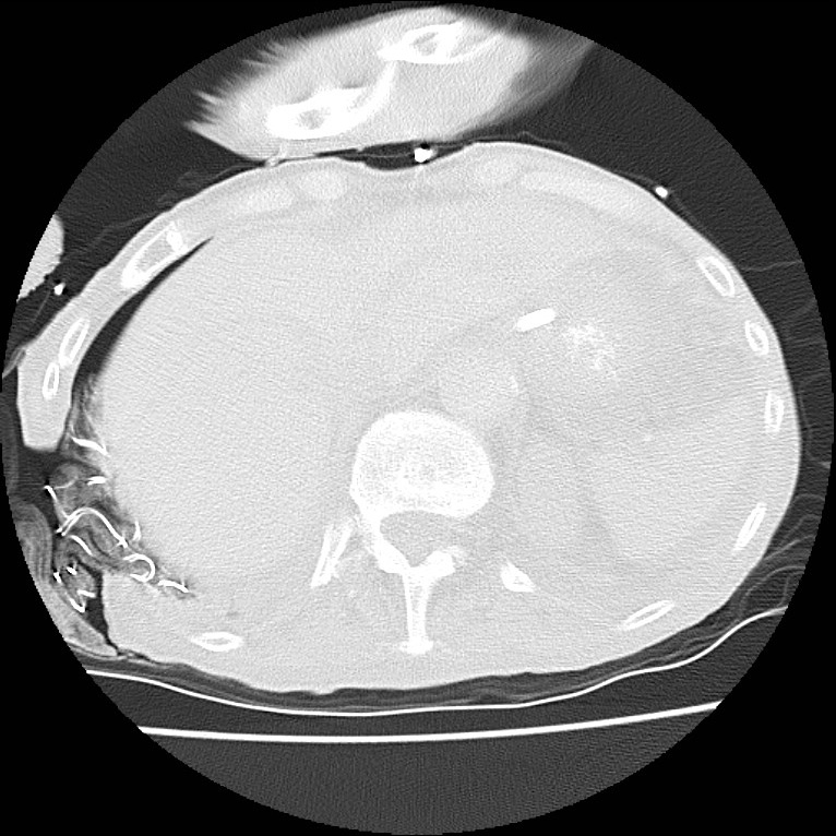Clagett thoracotomy with bronchopleural fistula (Radiopaedia 29192-29587 Axial lung window 48).jpg