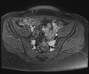 File:Class II Mullerian duct anomaly- unicornuate uterus with rudimentary horn and non-communicating cavity (Radiopaedia 39441-41755 Axial T1 fat sat 33).jpg