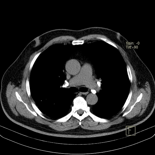 File:Classic complicated silicosis (Radiopaedia 49720-54961 Axial liver window 24).jpg