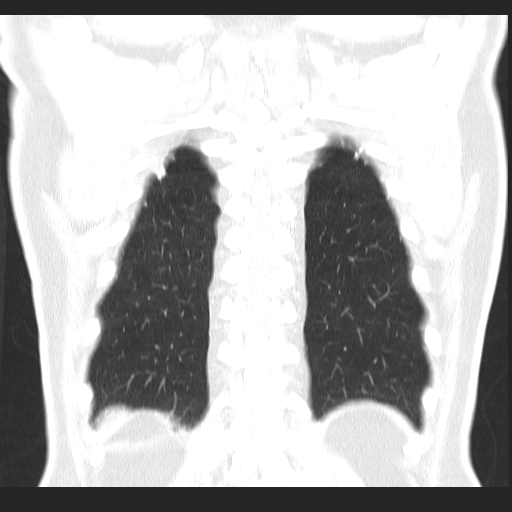 File:Classic complicated silicosis (Radiopaedia 49720-54961 Coronal lung window 54).jpg