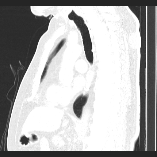 File:Classic complicated silicosis (Radiopaedia 49720-54961 Sagittal lung window 32).jpg