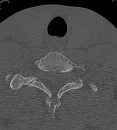 Clay-shoveler fracture (Radiopaedia 14604-14532 Axial bone window 38).jpg