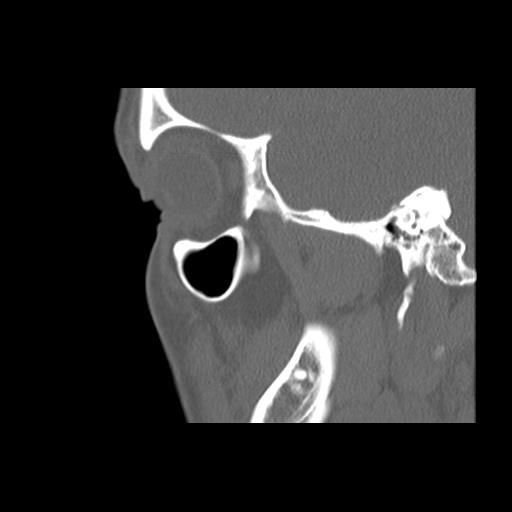 File:Cleft hard palate and alveolus (Radiopaedia 63180-71710 Sagittal bone window 14).jpg