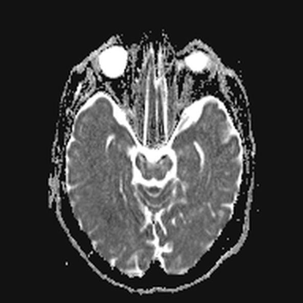 File:Clival meningioma (Radiopaedia 53278-59248 Axial ADC 9).jpg