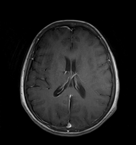 File:Clival meningioma (Radiopaedia 53278-59248 Axial T1 C+ 14).jpg