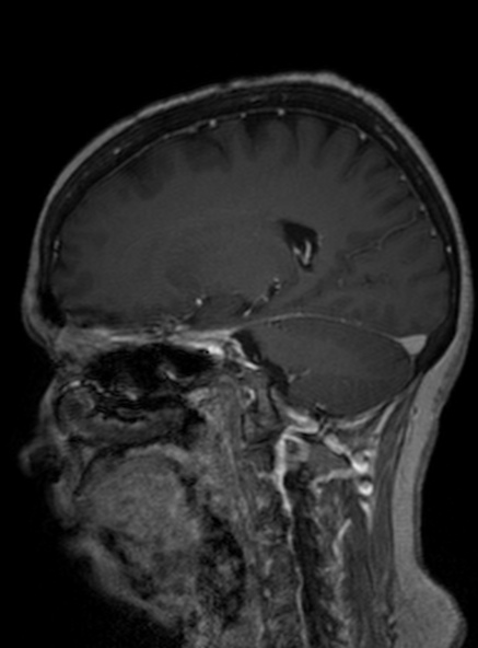 Clival meningioma (Radiopaedia 53278-59248 Sagittal T1 C+ 225).jpg
