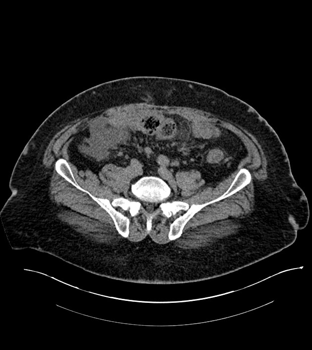Closed-loop small bowel obstruction-internal hernia (Radiopaedia 78439-91096 Axial non-contrast 112).jpg