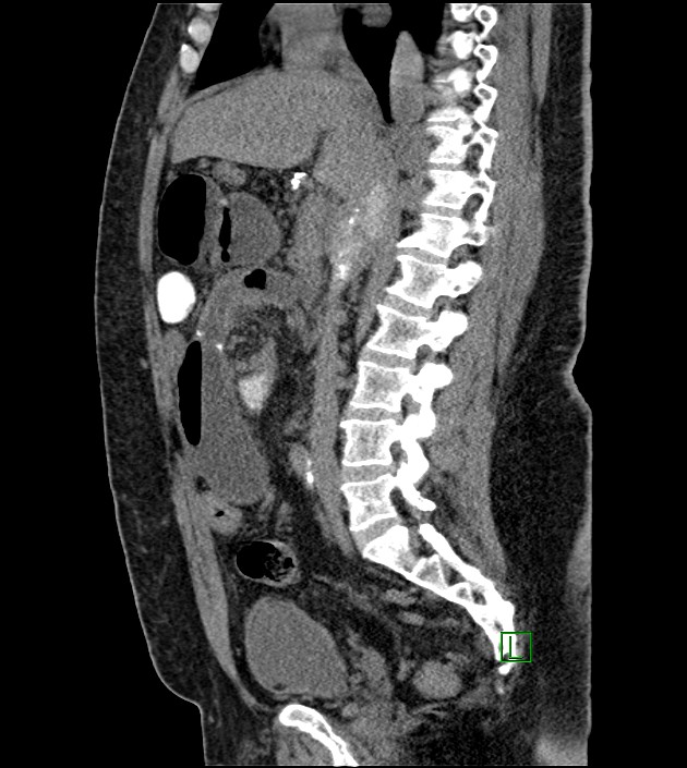 Closed-loop small bowel obstruction-internal hernia (Radiopaedia 78439-91096 C 82).jpg