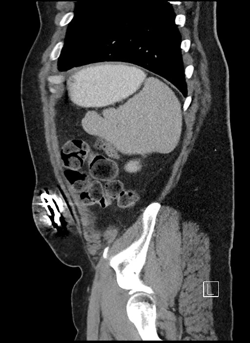 Closed loop obstruction - internal hernia into nephrectomy bed (Radiopaedia 59867-67320 C 8).jpg