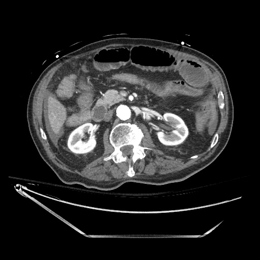 Closed loop obstruction due to adhesive band, resulting in small bowel ischemia and resection (Radiopaedia 83835-99023 B 62).jpg