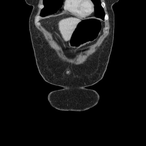 File:Closed loop small bowel obstruction (Radiopaedia 65403-74451 B 22).jpg