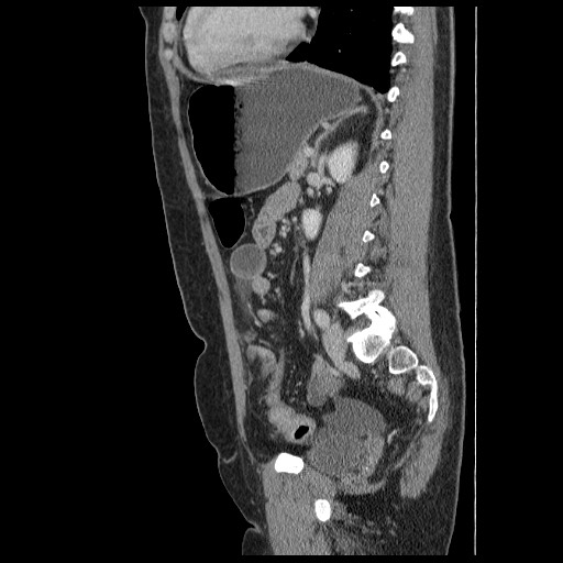 Closed loop small bowel obstruction (Radiopaedia 65403-74451 C 65).jpg