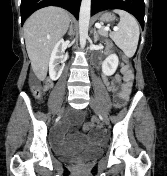 Closed loop small bowel obstruction (Radiopaedia 71211-81508 B 72).jpg