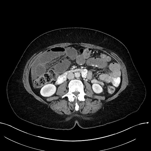 Closed loop small bowel obstruction - adhesions (Radiopaedia 59078-66369 A 61).jpg